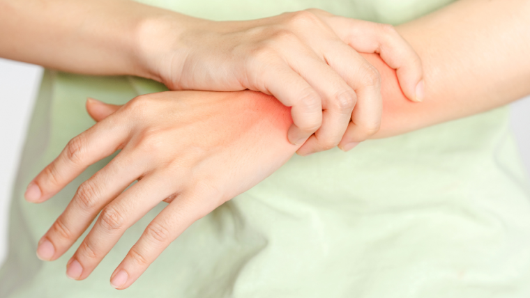 Can CBD treat symptoms of psoriasis and PsA?