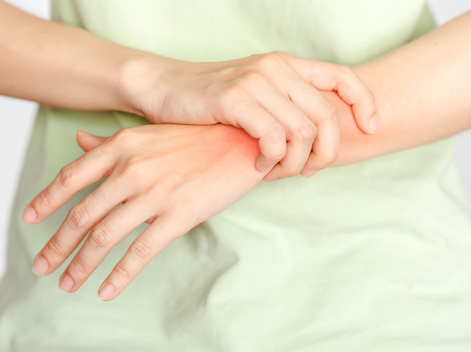 Can CBD treat symptoms of psoriasis and PsA?